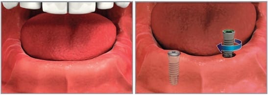 Image showing how dental implant procedure works - part 1