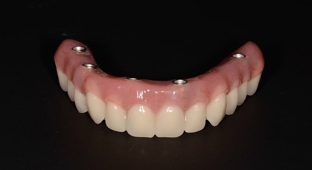 image of implant dentures