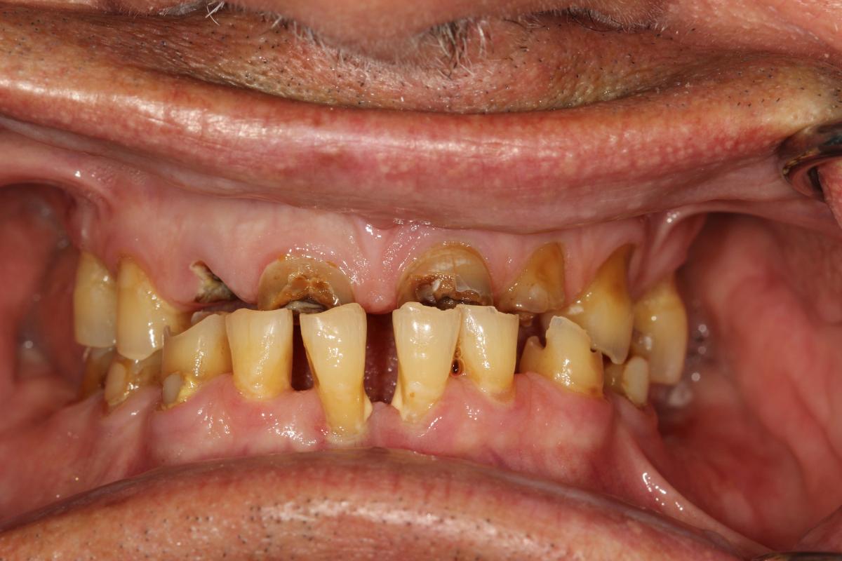 before image of Queensbury patient #5 - close up