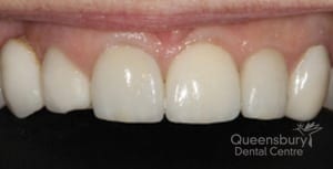 After image of patient with replaced crowns