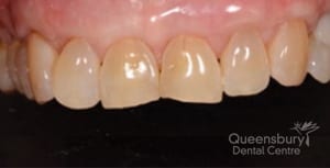 After image of patient going through gum grafting