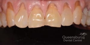 Before image of patient in need of gum grafting