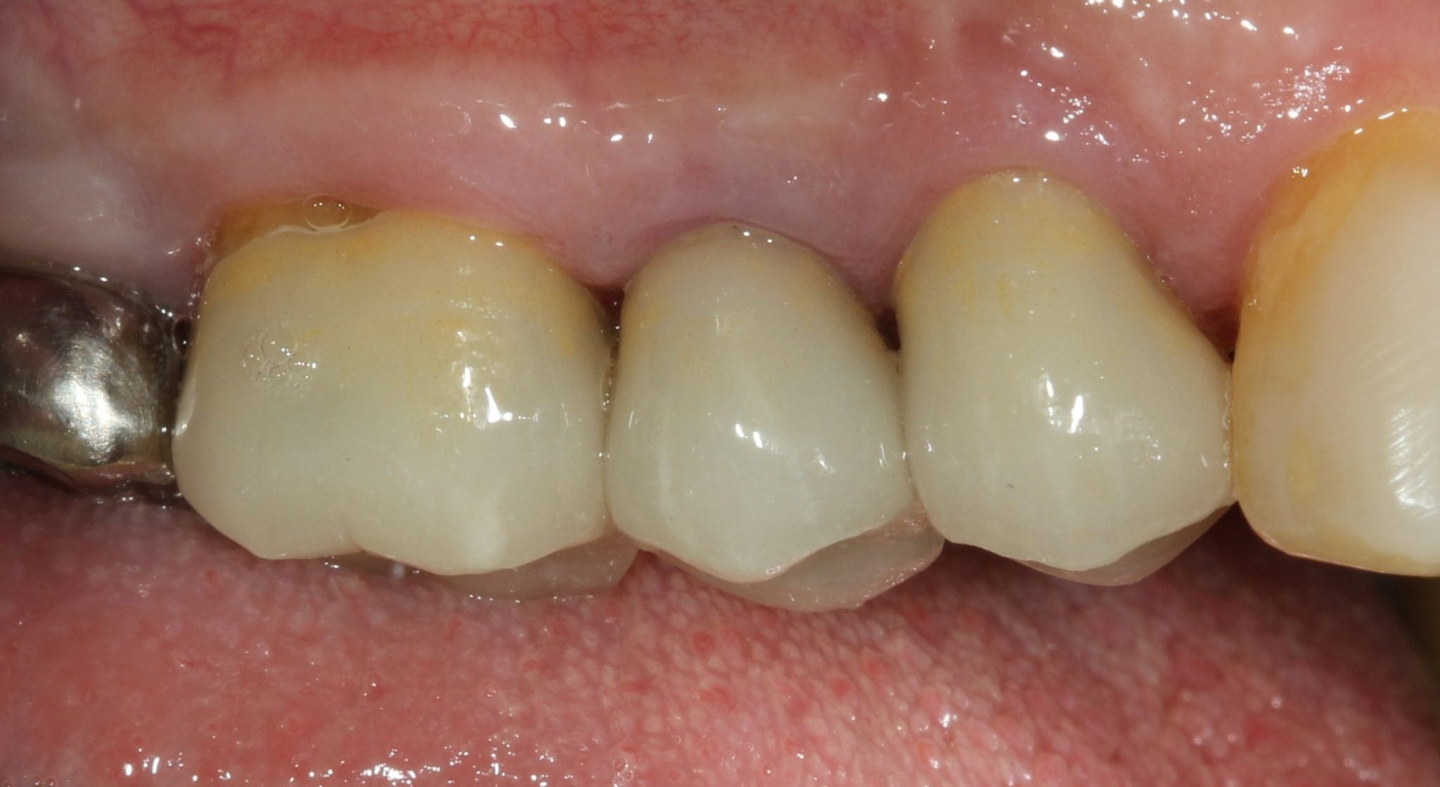 After image of patient who has had their dental crowns fixed by Queensbury dental centre