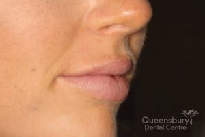 After image of a patient receiving a dermal filling