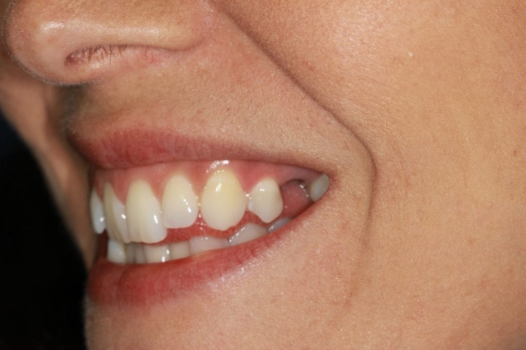 before image of patient getting a replacement tooth